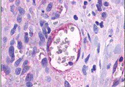 Immunohistochemistry-Paraffin: TEM5/GPR124 Antibody [NLS2167] - Human Skin, Kaposis Sarcoma capillary. Immunohistochemistry of formalin-fixed, paraffin-embedded tissue after heat-induced antigen retrieval.