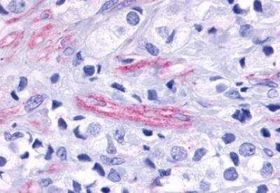 Immunohistochemistry-Paraffin: TEM5/GPR124 Antibody [NLS2167] - Human Prostate, Carcinoma Endothelial Cells. Immunohistochemistry of formalin-fixed, paraffin-embedded tissue after heat-induced antigen retrieval.