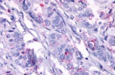 Immunohistochemistry-Paraffin: TEM5/GPR124 Antibody [NLS2167] - Human colon carcinoma, neoplastic cells. Immunohistochemistry of formalin-fixed, paraffin-embedded tissue after heat-induced antigen retrieval.