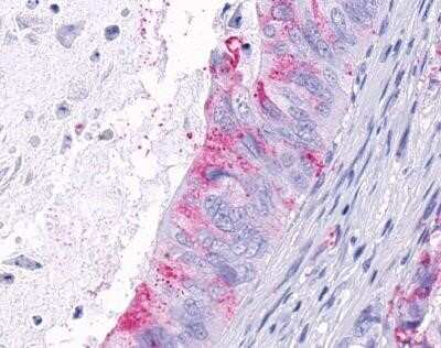 Immunohistochemistry-Paraffin: TEM5/GPR124 Antibody [NLS2171] - Analysis of anti-GPR124 / TEM5 antibody with human colon carcinoma, neoplastic cells.