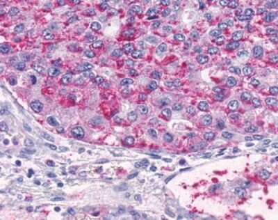 Immunohistochemistry-Paraffin: TEM5/GPR124 Antibody [NLS2171] - Analysis of anti-GPR124 / TEM5 antibody with human lung, adenocarcinoma.