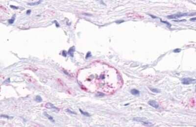 Immunohistochemistry-Paraffin: TEM5/GPR124 Antibody [NLS2171] - Anti-GPR124 / TEM5 antibody IHC of human Prostate, Carcinoma Capillary Endothelium. Immunohistochemistry of formalin-fixed, paraffin-embedded tissue after heat-induced antigen retrieval.