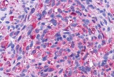 Immunohistochemistry-Paraffin: TEM5/GPR124 Antibody [NLS2171] - Anti-GPR124 / TEM5 antibody IHC of human Skin, Kaposis Sarcoma Tumor Endothelium. Immunohistochemistry of formalin-fixed, paraffin-embedded tissue after heat-induced antigen retrieval.