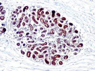 Immunohistochemistry-Paraffin: TFF1/pS2 Antibody (GE2 (same as R47/94)) - Azide and BSA Free [NBP2-34623] - Formalin-fixed paraffin-embedded human breast carcinoma stained with PS2 Monoclonal Antibody (GE2).