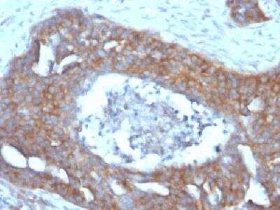 Immunohistochemistry-Paraffin: TFF1/pS2 Antibody (GE2 (same as R47/94)) - Azide and BSA Free [NBP2-34623] - Formalin-fixed paraffin-embedded human overian carcinoma stained with PS2 Monoclonal Antibody (GE2).