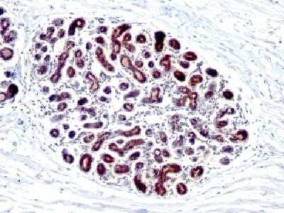 Immunohistochemistry-Paraffin: TFF1/pS2 Antibody (GE2 (same as R47/94)) - IHC-Prediluted [NBP2-44996] - Formalin-fixed paraffin-embedded human breast carcinoma stained with PS2 Monoclonal Antibody (GE2). Image using the Azide and BSA Free form of this antibody.