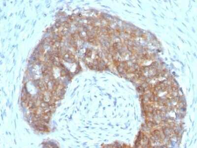 Immunohistochemistry-Paraffin: TFF1/pS2 Antibody (SPM313) - Azide and BSA Free [NBP2-48009] - Human Ovarian Carcinoma stained with pS2 Monoclonal Antibody (SPM313).