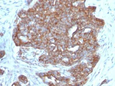 Immunohistochemistry-Paraffin: TFF1/pS2 Antibody (SPM573) - Azide and BSA Free [NBP2-34806] - Formalin-fixed, paraffin-embedded human Ovarian Carcinoma stained with TFF1/pS2 Antibody (SPM573).