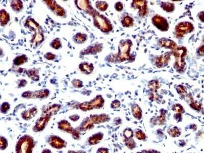 Immunohistochemistry-Paraffin: TFF1/pS2 Antibody (TFF1/1091) - Azide and BSA Free [NBP2-48010] - Human Breast Carcinoma stained with pS2 Monoclonal Antibody (TFF1/1091).