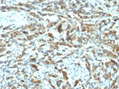 Immunohistochemistry-Paraffin: TFF1/pS2 Antibody (TFF1/2133) [NBP3-08247] - Formalin-fixed, paraffin-embedded human Breast Carcinoma stained with TFF1/pS2 Mouse Monoclonal Antibody (TFF1/2133).