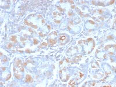 Immunohistochemistry-Paraffin: TFF1/pS2 Antibody (TFF1/2969R) - Azide and BSA Free [NBP3-08252] - Formalin-fixed, paraffin-embedded human Stomach Carcinoma stained with TFF1/pS2 Rabbit Recombinant Monoclonal Antibody (TFF1/2969R).