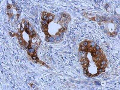 Immunohistochemistry-Paraffin: TFF1/pS2 Antibody (pS2.1) [NB120-3079] - Analysis of Trefoil factor 1 in paraffin-embedded gastric carcinoma using a Trefoil factor 1 polyclonal antibody.