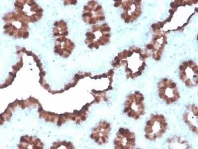 Immunohistochemistry-Paraffin: TFF1/pS2 Antibody (rTFF1/1091) [NBP3-07342] - Formalin-fixed, paraffin-embedded human Breast Carcinoma stained with TFF1/pS2 Mouse Monoclonal Antibody (rTFF1/1091).
