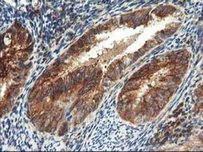 Immunohistochemistry: TFG Antibody (OTI2C3) - Azide and BSA Free [NBP2-74491] - Staining of paraffin-embedded Adenocarcinoma of Human endometrium tissue using anti-TFG mouse monoclonal antibody.