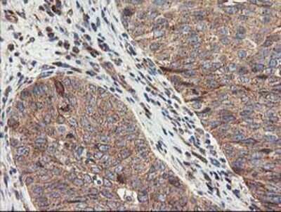 Immunohistochemistry: TFG Antibody (OTI2C3) - Azide and BSA Free [NBP2-74491] - Staining of paraffin-embedded Carcinoma of Human bladder tissue using anti-TFG mouse monoclonal antibody.