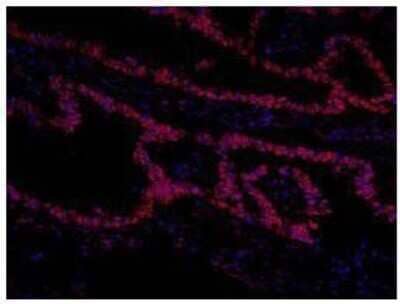 Immunocytochemistry/Immunofluorescence: TFII-I Antibody [NB100-61054] - FFPE section of human colon carcinoma.  Affinity purified rabbit anti-GTF2I/TF II-I used at a dilution of 1:100.