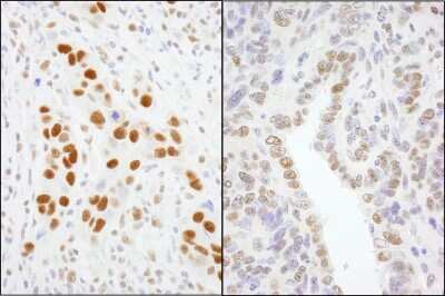 <b>Independent Antibodies Validation. </b>Immunohistochemistry: TFII-I Antibody [NB100-61053] - Sample: FFPE section of human breast carcinoma (left) and mouse teratoma (right). Antibody: Affinity purified rabbit anti-GTF2I/TFII-I used at a dilution of 1:200 (1ug/ml). Detection: DAB