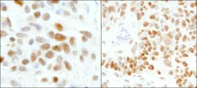 Immunohistochemistry: TFII-I Antibody [NB100-61054] - Sample: FFPE section of human Ewing sarcoma (left) and mouse teratoma (right). Antibody: Affinity purified rabbit anti-GTF2I/TFII-I used at a dilution of 1:200 (1ug/ml). Detection: DAB