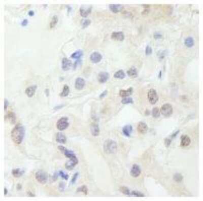 Immunohistochemistry-Paraffin: TFIIIC Antibody [NB100-60656] - FFPE section of human  thyroid carcinoma.   Affinity purified rabbit anti-TFIIIC used at a dilution of 1:250. Detection: DAB staining using Immunohistochemistry Accessory Kit