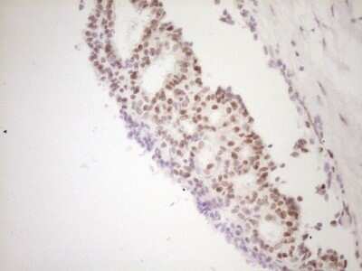 Immunohistochemistry: TFPI Antibody (OTI5H5) - Azide and BSA Free [NBP2-74493] - Analysis of Adenocarcinoma of Human breast tissue. (Heat-induced epitope retrieval by 1 mM EDTA in 10mM Tris, pH8.5, 120C for 3min)