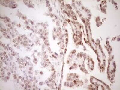 Immunohistochemistry: TFPI Antibody (OTI5H5) - Azide and BSA Free [NBP2-74493] - Analysis of Adenocarcinoma of Human ovary tissue. (Heat-induced epitope retrieval by 1 mM EDTA in 10mM Tris, pH8.5, 120C for 3min)