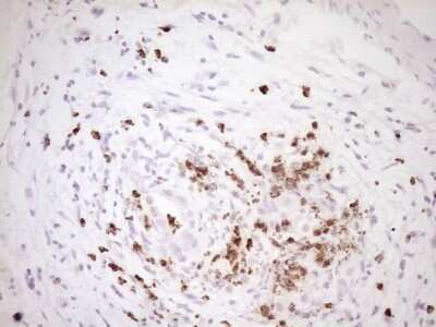 Immunohistochemistry: TFPI Antibody (OTI5H5) - Azide and BSA Free [NBP2-74493] - Analysis of Carcinoma of Human pancreas tissue. (Heat-induced epitope retrieval by 1 mM EDTA in 10mM Tris, pH8.5, 120C for 3min)