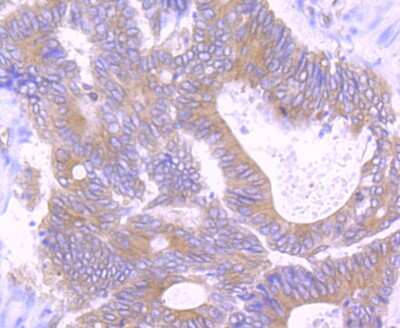 Immunohistochemistry-Paraffin: TGF-alpha Antibody (JB58-36) [NBP2-75682] - Analysis of paraffin-embedded human colon cancer tissue using anti-TGF alpha antibody. Counter stained with hematoxylin.