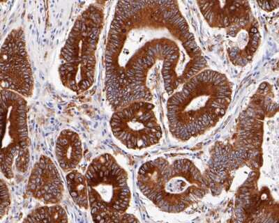 Immunohistochemistry-Paraffin: TGF-alpha Antibody (JB58-36) [NBP2-75682] - Immunohistochemical analysis of paraffin-embedded human colon cancer tissue using anti-TGF-alpha antibody. Counter stained with hematoxylin.