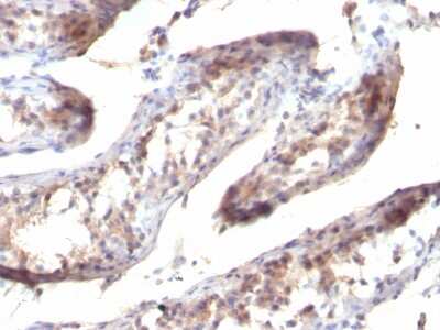 Immunohistochemistry-Paraffin: TGF-alpha Antibody (SPM357) - Azide and BSA Free [NBP3-08270] - Formalin-fixed, paraffin-embedded human Testicular Carcinoma stained with TGF-alpha Mouse Monoclonal Antibody (SPM357)