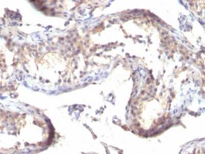 Immunohistochemistry-Paraffin: TGF-alpha Antibody (TGFA/1119) [NBP2-45142] - Human Testicular Carcinoma stained with TGF alpha Monoclonal Antibody (TGFA/1119)