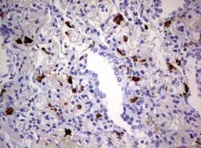 Immunohistochemistry: TGIF1 Antibody (1B12) [NBP2-46109] - Analysis of Carcinoma of Human lung tissue. (Heat-induced epitope retrieval by 10mM citric buffer, pH6.0, 120C for 3min)