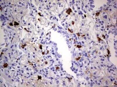 Immunohistochemistry: TGIF1 Antibody (OTI1B12) - Azide and BSA Free [NBP2-74496] - Analysis of Carcinoma of Human lung tissue. (Heat-induced epitope retrieval by 10mM citric buffer, pH6.0, 120C for 3min)