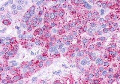 Immunohistochemistry-Paraffin: TGR5/GPBAR1 Antibody [NLS1937] - Analysis of anti-GPBAR1 / TGR5 antibody with human ovary, carcinoma.