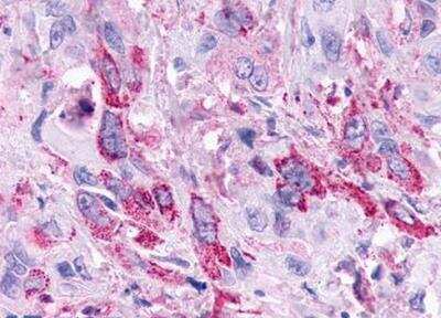 Immunohistochemistry-Paraffin: TGR5/GPBAR1 Antibody [NLS1937] - Analysis of anti-GPBAR1 / TGR5 antibody with human pancreas, carcinoma.