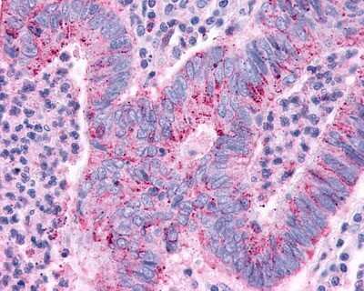 Immunohistochemistry-Paraffin: TGR5/GPBAR1 Antibody [NLS1937] - Analysis of anti-GPBAR1 / TGR5 antibody with human colon, carcinoma.