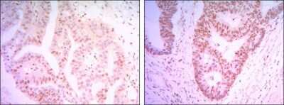 Immunohistochemistry-Paraffin: THAP11 Antibody (3F3) [NBP1-51638] - Analysis of paraffin-embedded colon cancer tissues (left) and ovary cancer tissues (right) using THAP11 mouse mAb with DAB staining.
