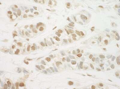 Immunohistochemistry: THRAP2 Antibody [NBP2-04087] - Sample: FFPE section of human breast carcinoma. Antibody: Affinity purified rabbit anti-MED13L used at a dilution of 1:250 Detection: DAB staining