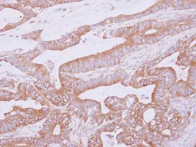 Immunohistochemistry-Paraffin: THUMPD2 Antibody [NBP2-20625] - Immunohistochemical analysis of paraffin-embedded Colon ca, using antibody at 1:500 dilution.