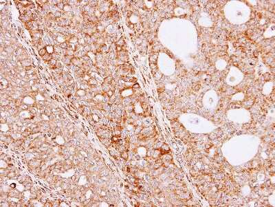 Immunohistochemistry-Paraffin: THUMPD3 Antibody [NBP1-32500] - Paraffin-embedded Serous OVCA xenograft, using antibody at 1:100 dilution.
