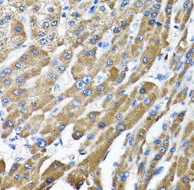 Immunohistochemistry-Paraffin: THUMPD3 Antibody [NBP2-93482] - Human liver cancer using THUMPD3 Rabbit pAb at dilution of 1:200 (40x lens).