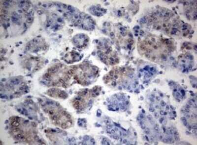 Immunohistochemistry: TIA1 Antibody (OTI1D7) - Azide and BSA Free [NBP2-74513] - Analysis of Carcinoma of Human liver tissue.(Heat-induced epitope retrieval by 10mM citric buffer, pH6.0, 120C for 3min)