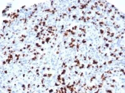 Immunohistochemistry-Paraffin: TIA1 Antibody (TIA1/1352R) [NBP3-13791] - Formalin-fixed, paraffin-embedded human lymph node stained with TIA1 antibody (TIA1/1352R). HIER: Tris/EDTA, pH9.0, 45min. HRP-polymer, 30min. DAB, 5min.