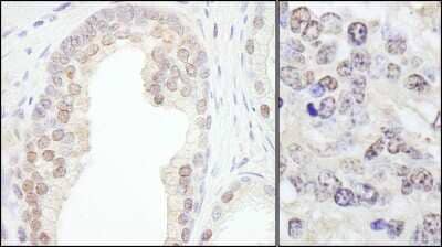 <b>Biological Strategies Validation. </b>Immunohistochemistry-Paraffin: TIF1 gamma Antibody [NB100-57498] - Section of human prostate carcinoma (left) and mouse teratoma (right). Antibody: Affinity purified rabbit anti- TRIM33/TIF1gamma used at a dilution of 1:200 (1ug/ml). Detection: DAB