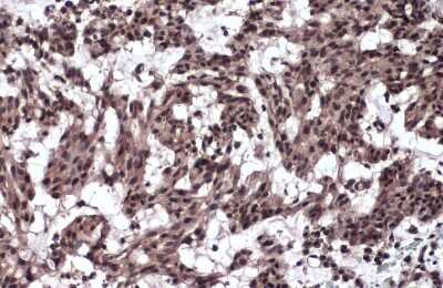 Immunohistochemistry-Paraffin: TIF1 gamma Antibody [NBP3-13036] - Human breast carcinoma. TIF1 gamma stained by TIF1 gamma antibody (NBP3-13036) diluted at 1:1000. Antigen Retrieval: Citrate buffer, pH 6.0, 15 min.