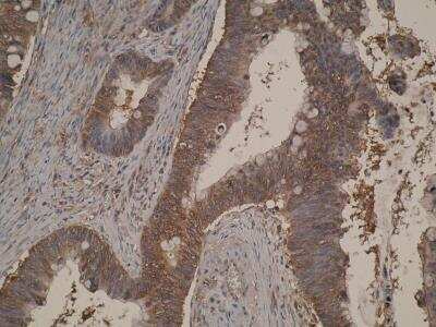 Immunohistochemistry: TIGAR/C12orf5 Antibody (M2-P4H2) [NB100-2698] - Antibody staining of colon cancer tissue.