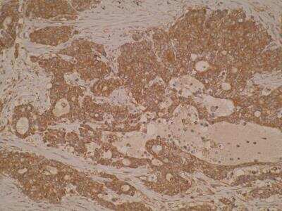 Immunohistochemistry: TIGAR/C12orf5 Antibody (M2-P4H2) [NB100-2698] - Formalin-fixed,paraffin-embedded human colorectal cancer tissue using TIGAR/C12orf5 Antibody (M2-P4H2), showing strong cytoplasmic and nuclear staining.