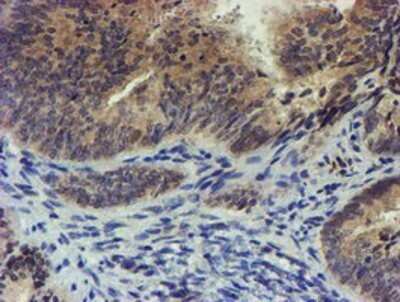 Immunohistochemistry: TIGD1 Antibody (OTI4G9) - Azide and BSA Free [NBP2-74519] - Staining of paraffin-embedded Adenocarcinoma of Human endometrium tissue using anti-TIGD1 mouse monoclonal antibody.