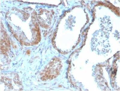 Immunohistochemistry-Paraffin: TIGIT Antibody (TIGIT/3106) - Azide and BSA Free [NBP2-79928] - Formalin-fixed, paraffin-embedded human Prostate Carcinoma stained with TIGIT-Monospecific Mouse Monoclonal Antibody (TIGIT/3106).