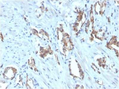 Immunohistochemistry-Paraffin: TIGIT Antibody (TIGIT/3106) - Azide and BSA Free [NBP2-79928] - Formalin-fixed, paraffin-embedded human prostate carcinoma stained with Biotin-conjugated TIGIT Mouse Monoclonal Antibody (TIGIT/3106).