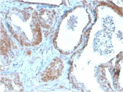 Immunohistochemistry-Paraffin: TIGIT Antibody (TIGIT/3106) [NBP2-79794] - Formalin-fixed, paraffin-embedded human Prostate Carcinoma stained with TIGIT Antibody (TIGIT/3106).